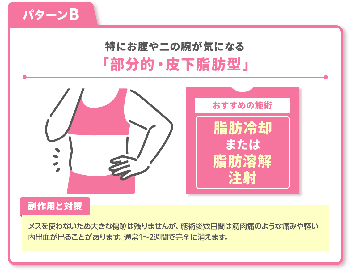 パターンB：特にお腹や二の腕が気になる「部分的・皮下脂肪型」